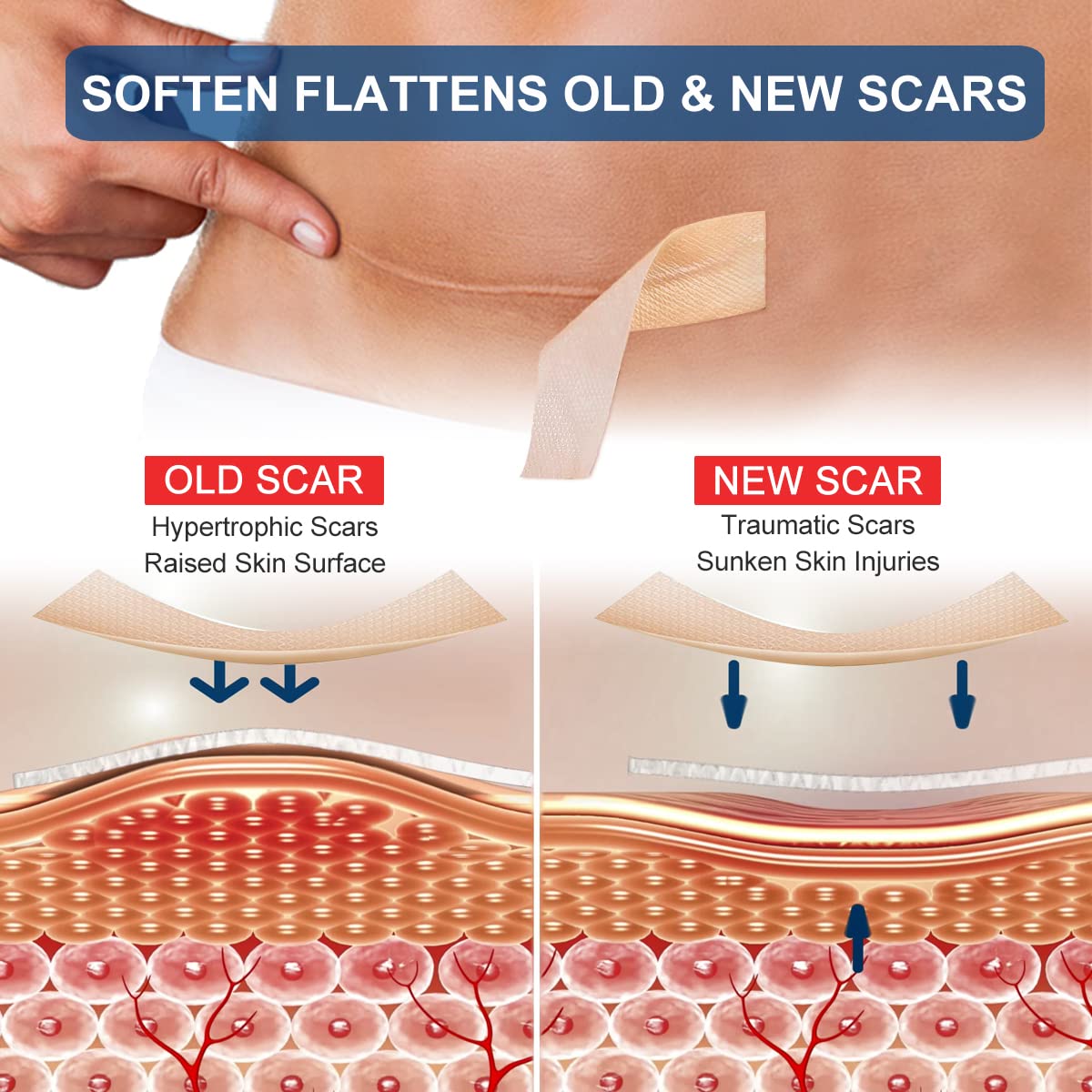 Silicone Scar Sheet Roll