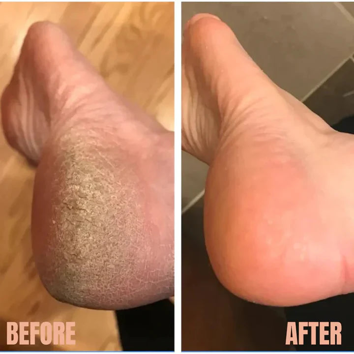 Glowie SmoothSpin™ Callus Remover Roller